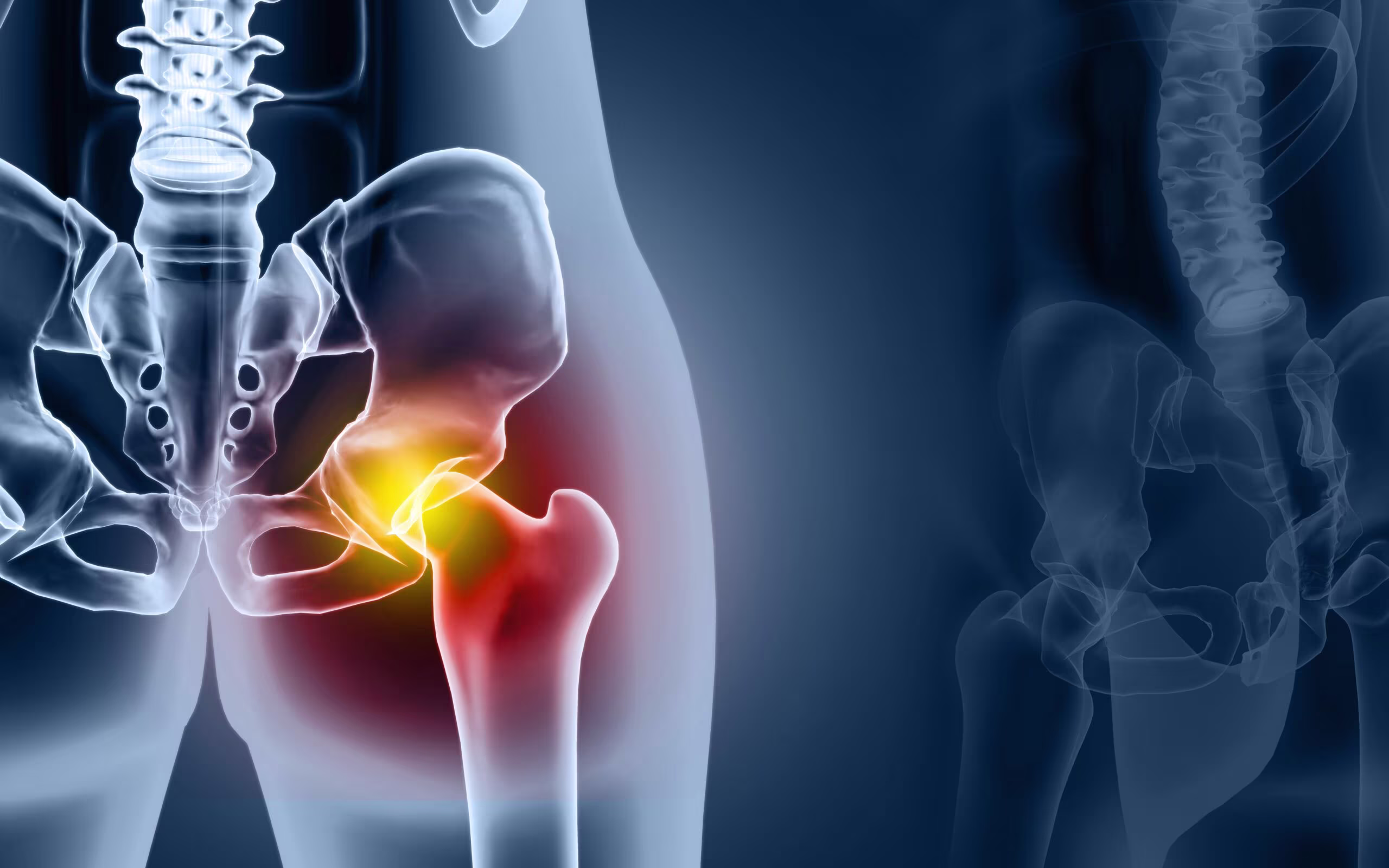 illustrasjon av Artrose i hoften