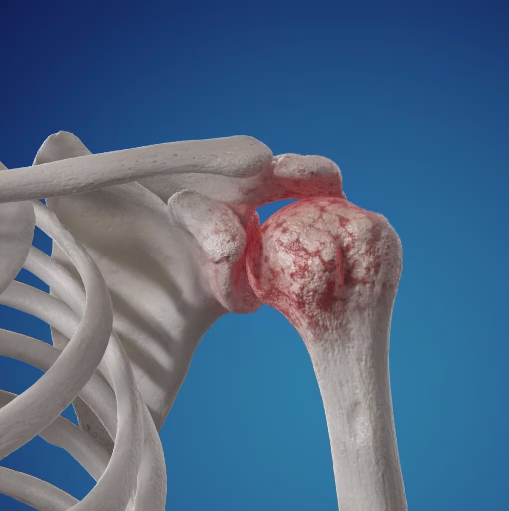 Illustrasjon av Artrose i skulderen